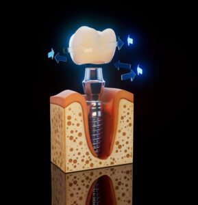 زراعة الأسنان